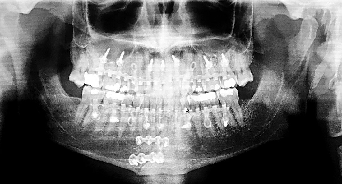 Panorex X-Ray of Maxillofacial Region