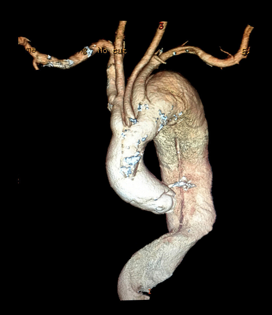 Aortic Dissection, 3D CTA