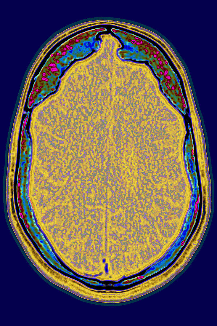 Alzheimer's disease, CT scan