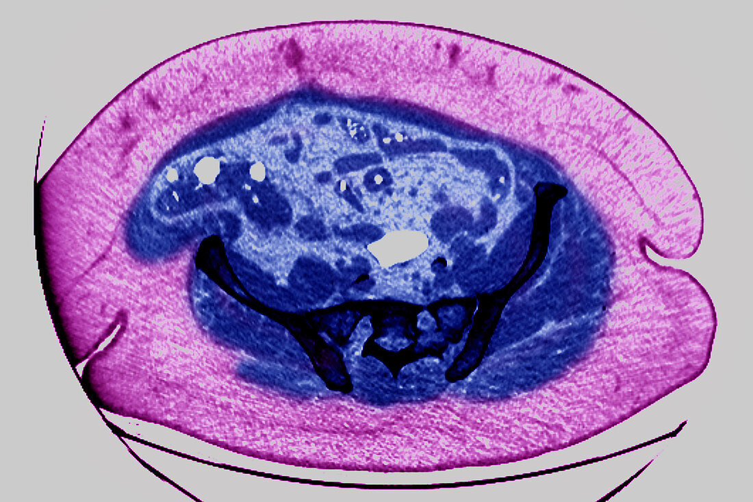 Obesity, CT scan