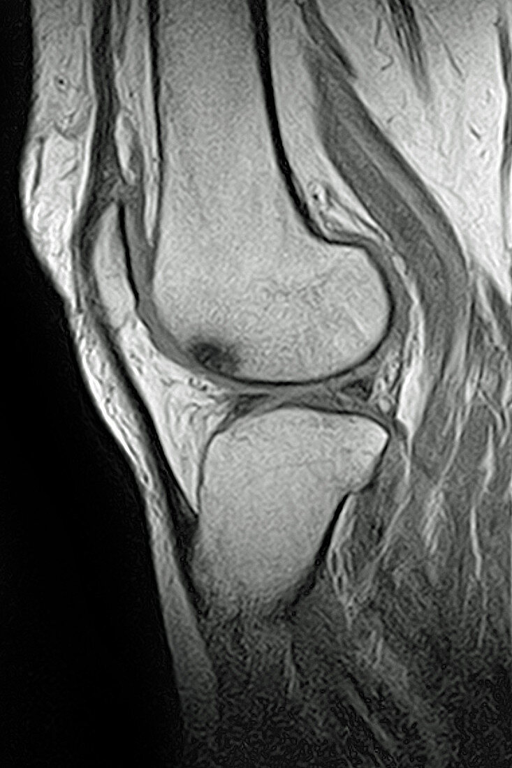 Edema of the knee, MRI