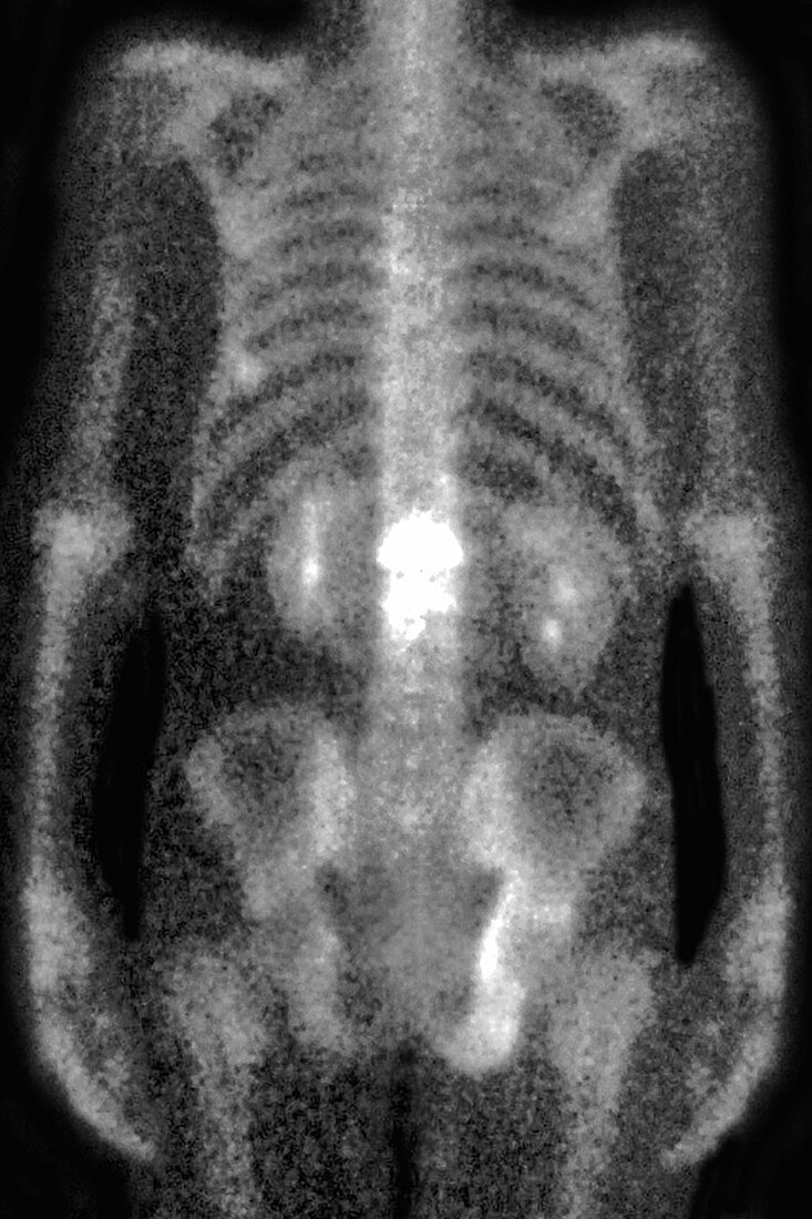 Osteoporosis of lumbar vertebrae, body scintigram