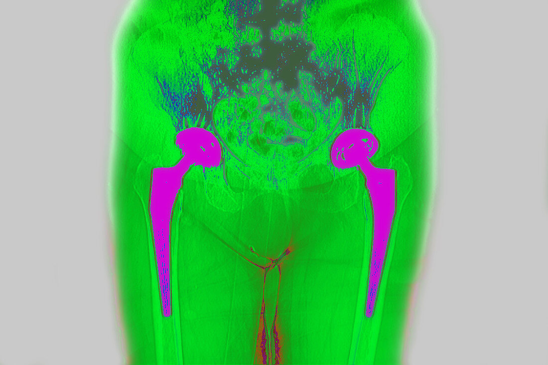 Total hip prostheses, X-ray