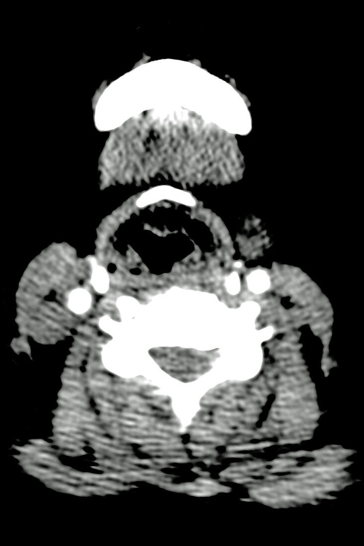 Heterogeneous thyroid, CT scan