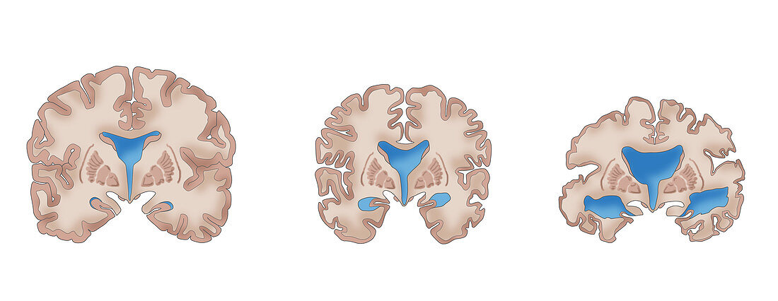 Alzheimer's Brain Progression, illustration