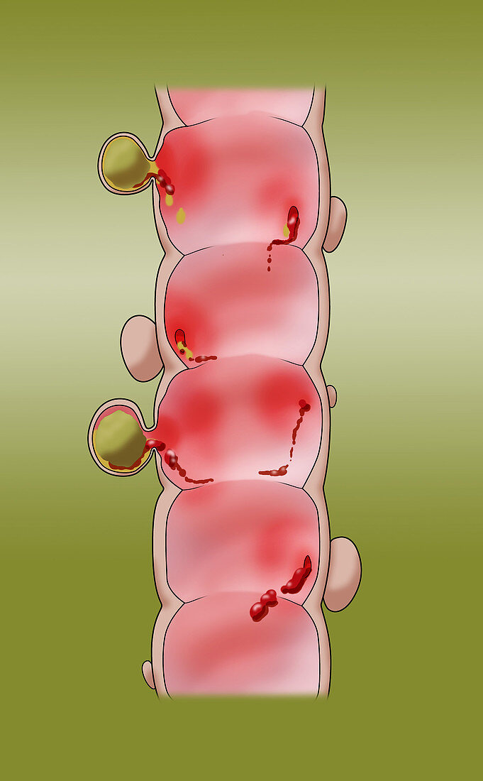 Colon with Diverticulitis, illustration