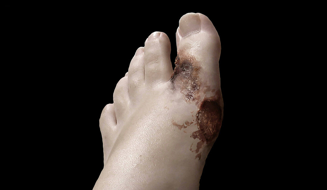Foot with Gangrene