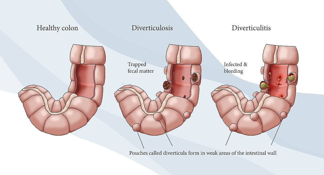 Diverticulosis and Diverticulitis, illustration