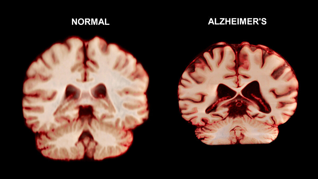 Normal Brain vs. Alzheimer's Disease, MRI Scan