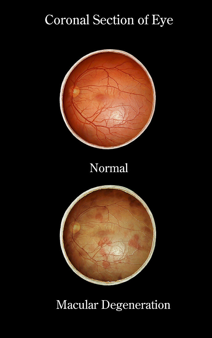 Eye, Normal vs Macular Degeneration