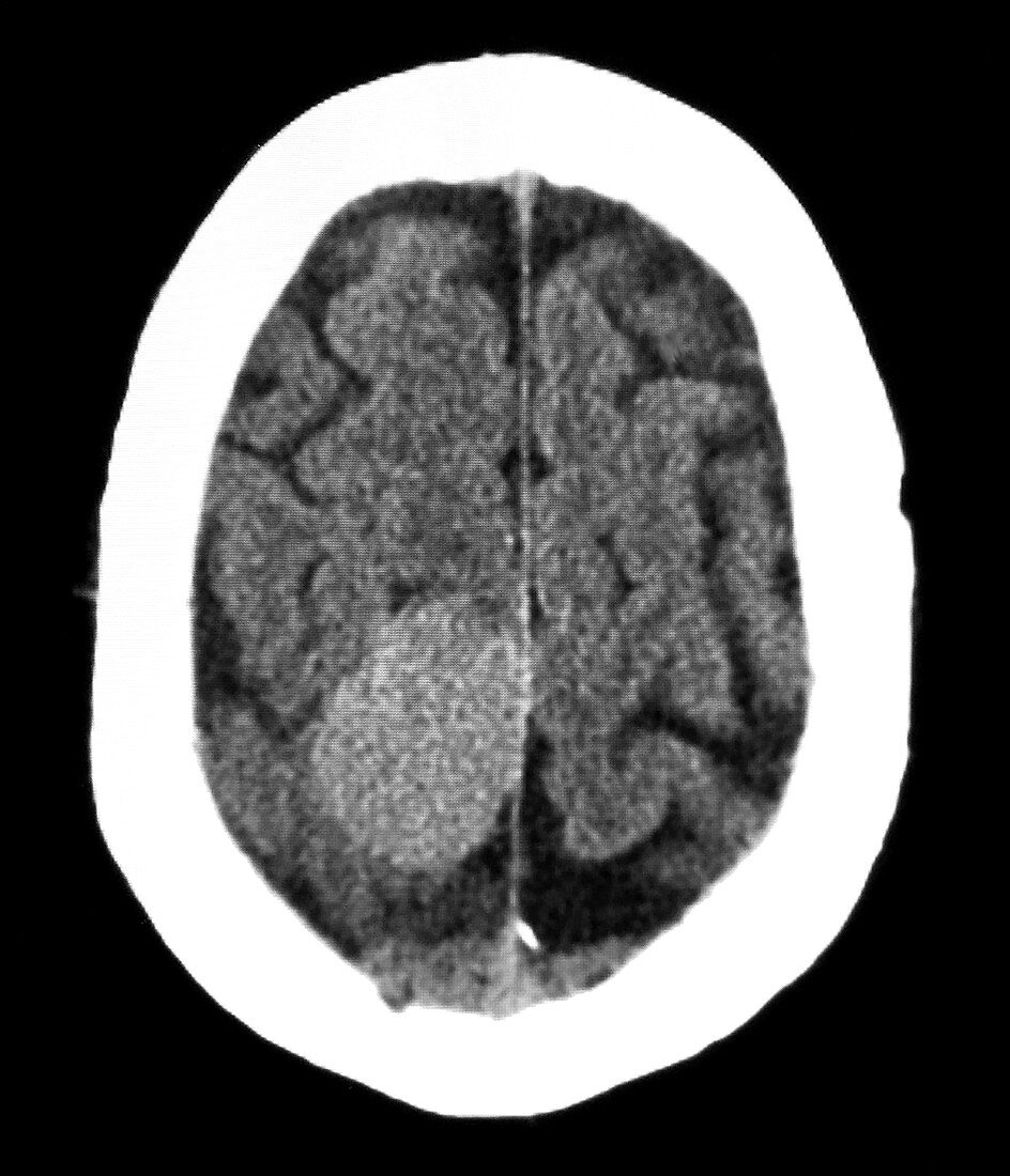 Meningioma at Vertex, MRI