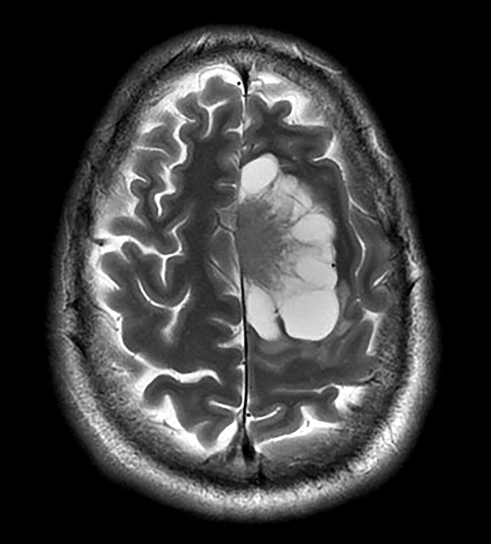 Cystic Meningioma, MRI
