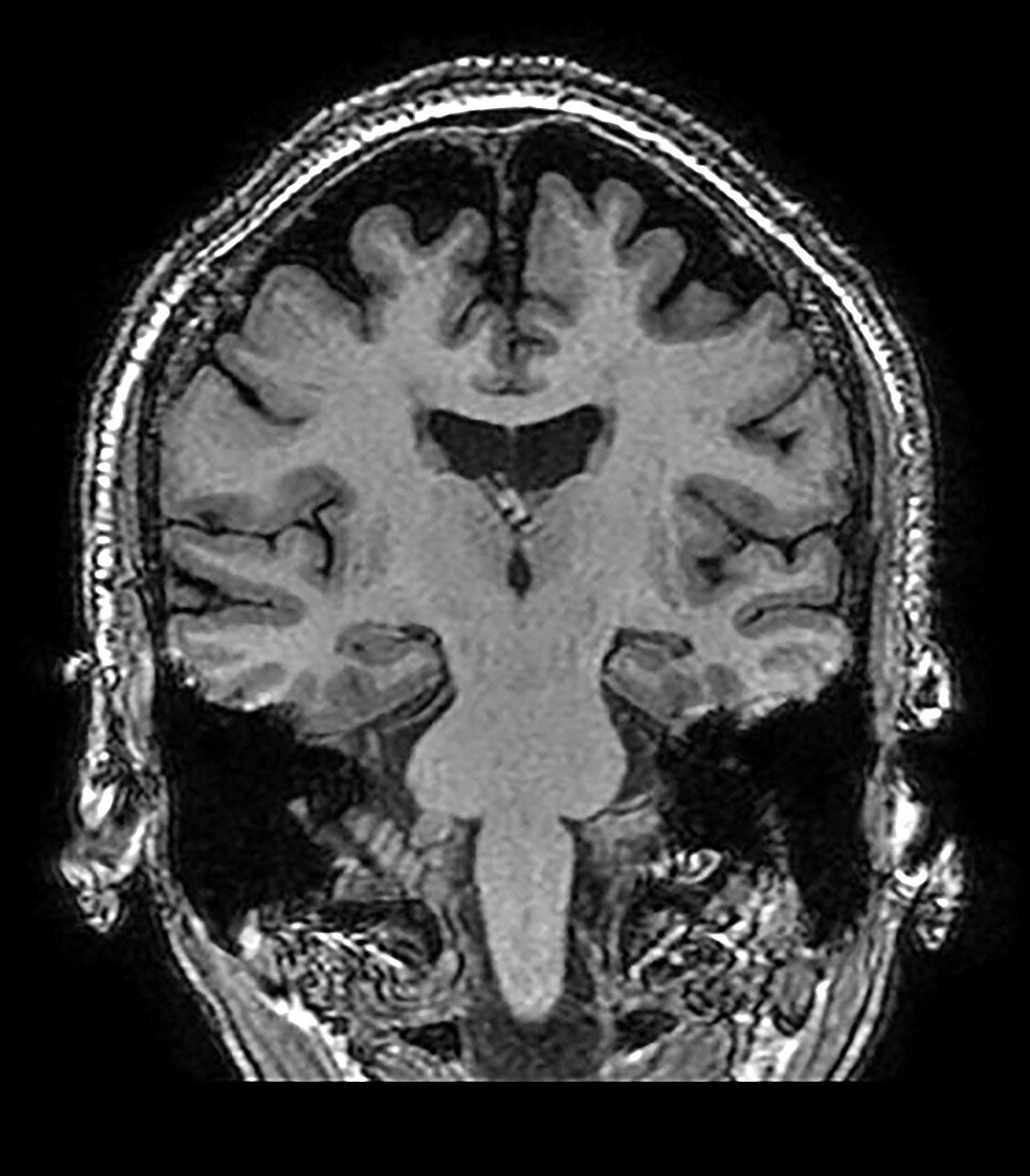 Mesial Temporal Sclerosis, MRI