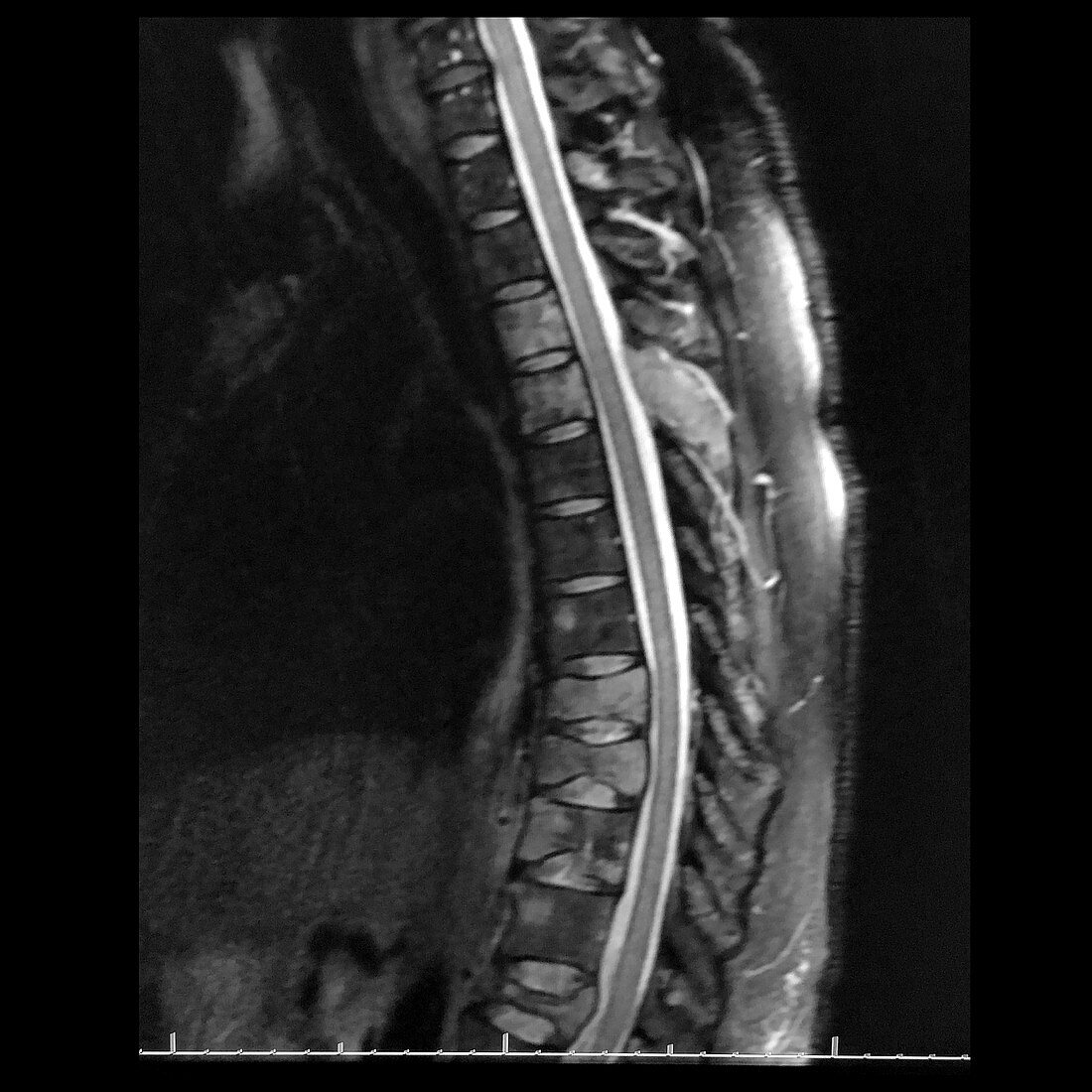 Metastatic Lung Cancer to Thoracic Spine, MRI