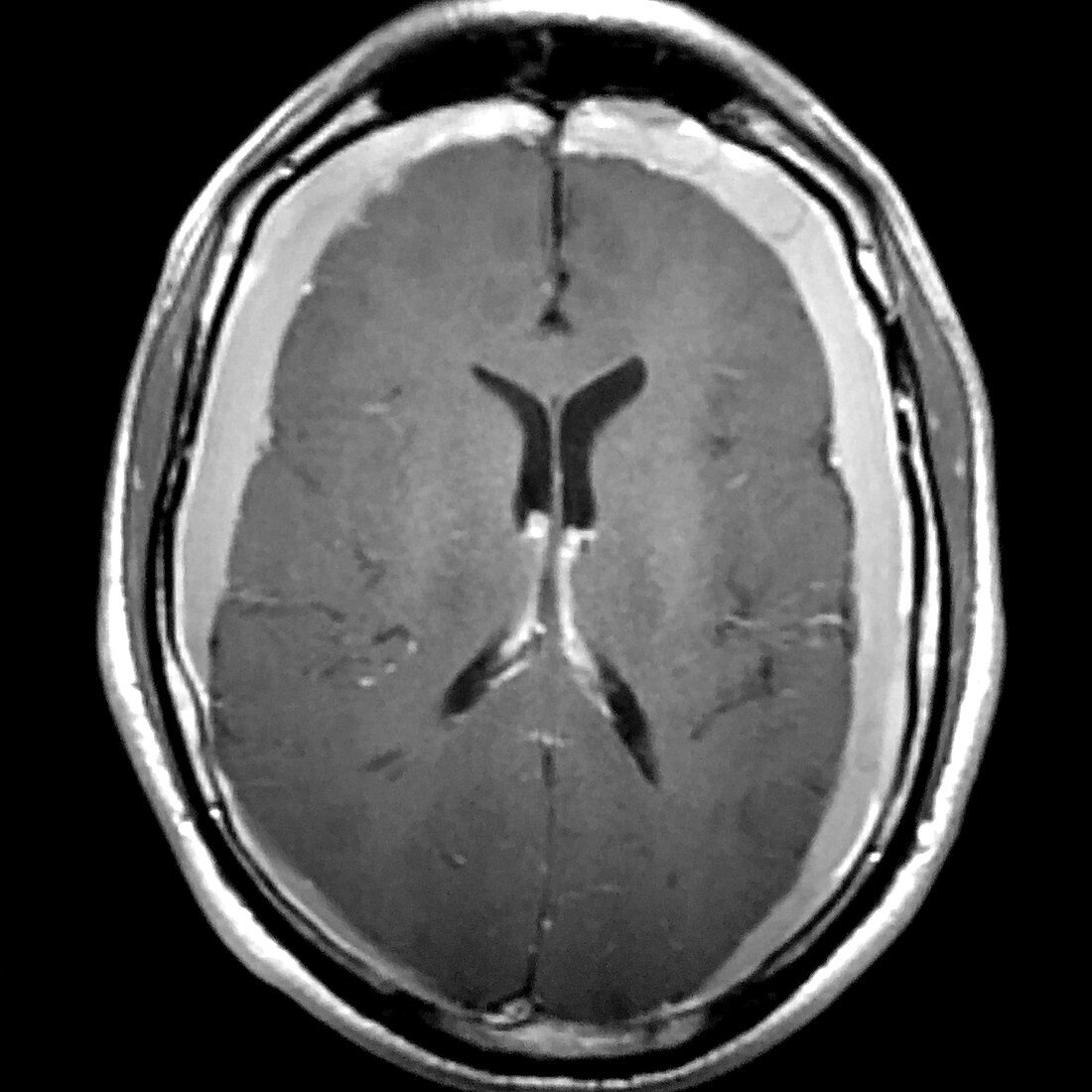 Bilateral Subdural Hematomas, MRI