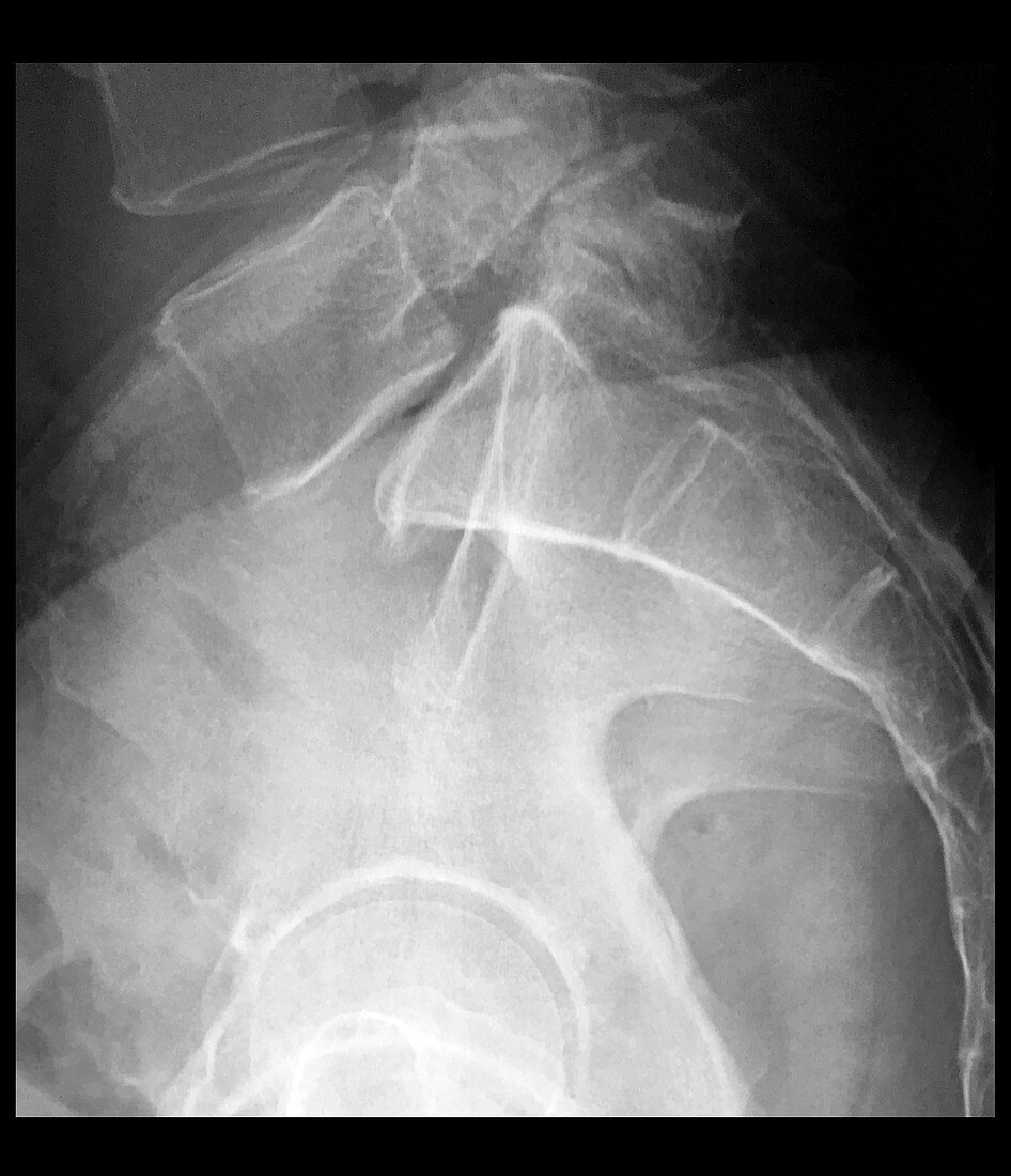 X-Ray of Spondylolisthesis