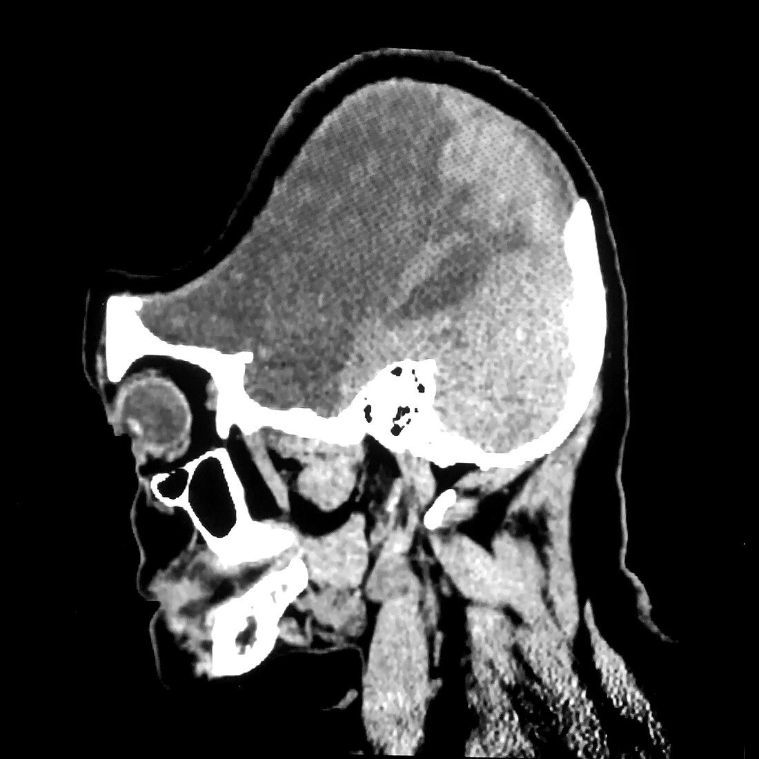 Sunken Flap Syndrome, CT