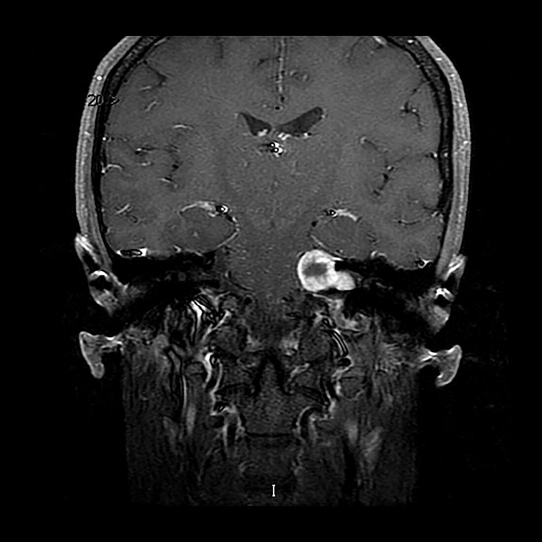 Vestibular Schwannoma, MRI