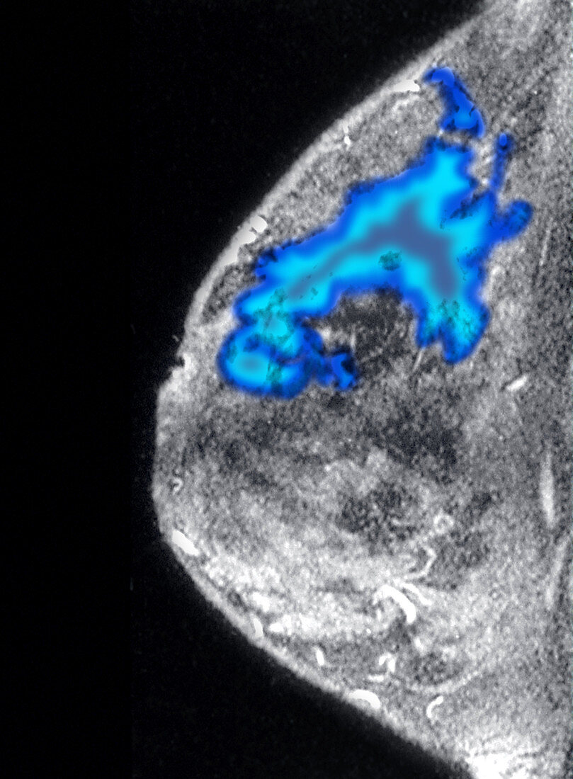 Breast Cancer, MRI