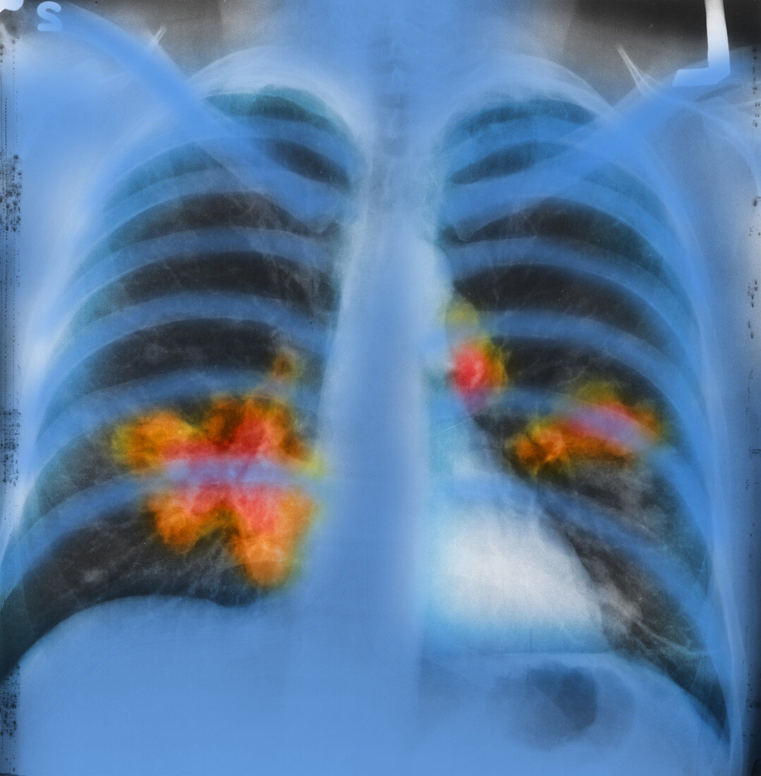 Lung Cancer, Chest X-Ray