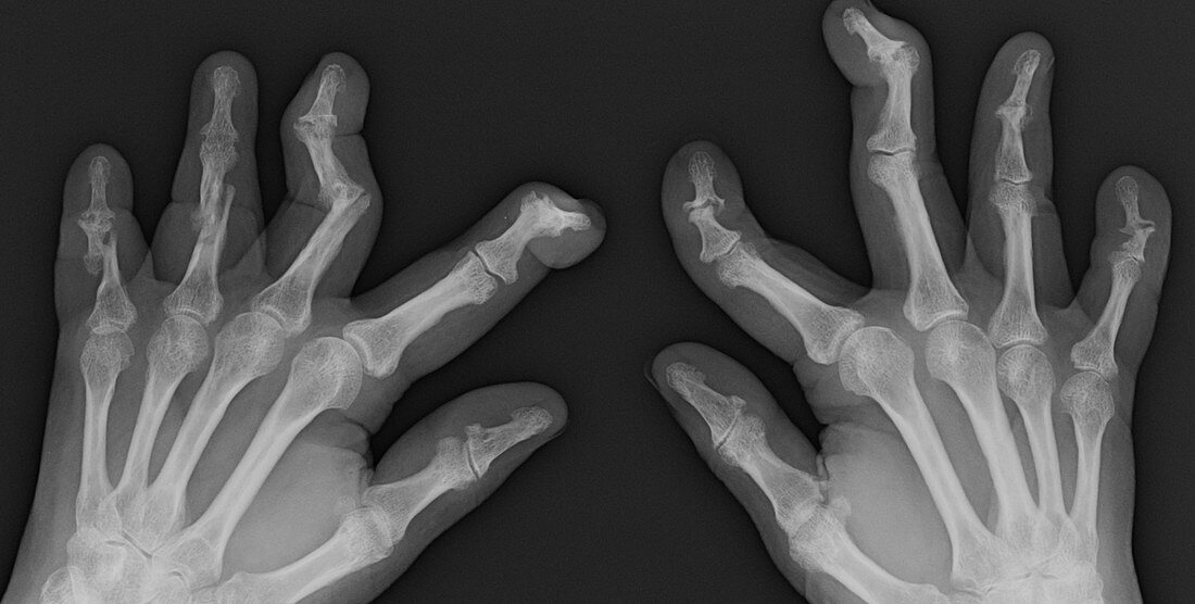 Psoriatic Arthritis, X-ray