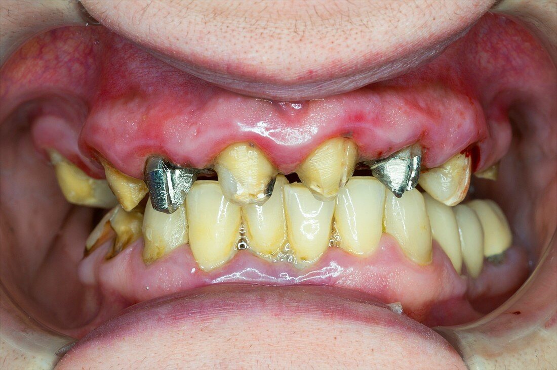 Tooth preparation for dental crowns