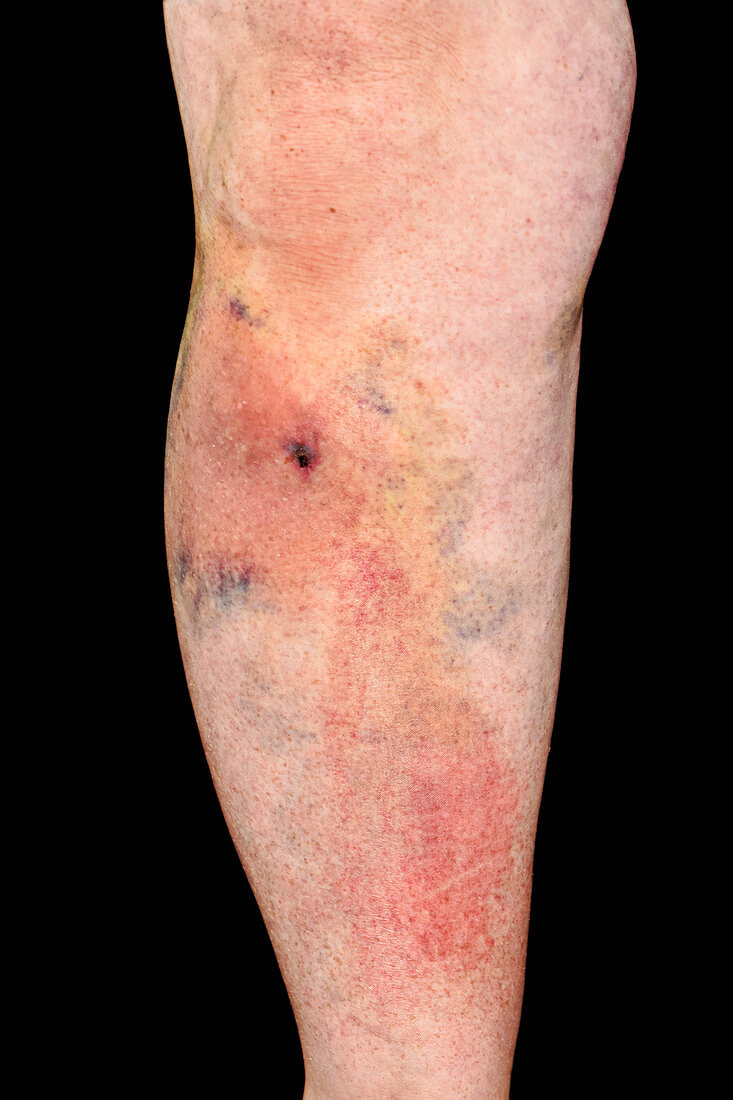 Haematoma on leg following an accident