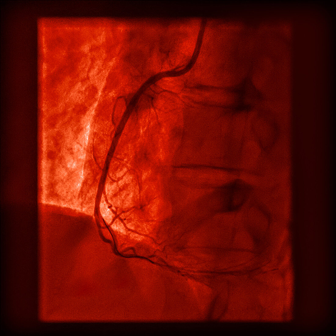 Coronaries after trans-luminal angioplasty (ATL)