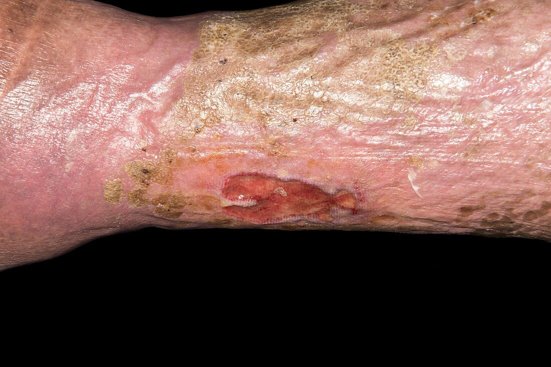 Chronic leg ulcers