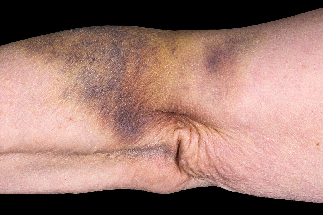 Bruised arm from blood sampling