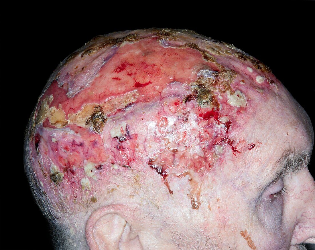 Basal cell carcinomas of the scalp