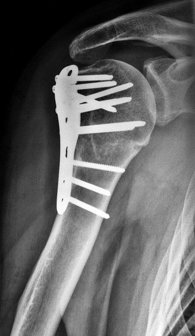Pinned humerus, X-ray