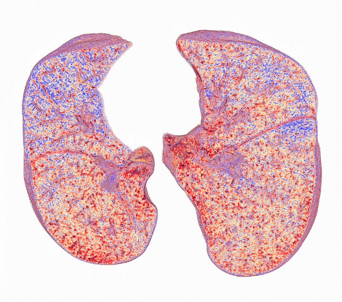 Aeration pattern in lungs, 3D CT scan