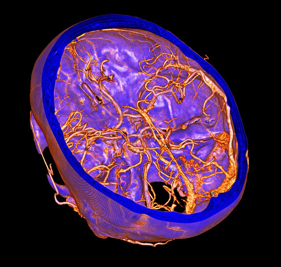 Intracranial blood vessels, 3D CT scan