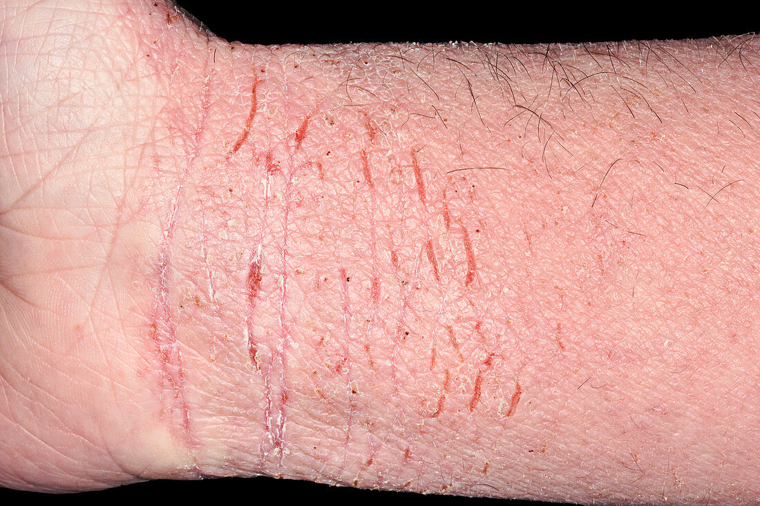 Severe eczema on the wrist