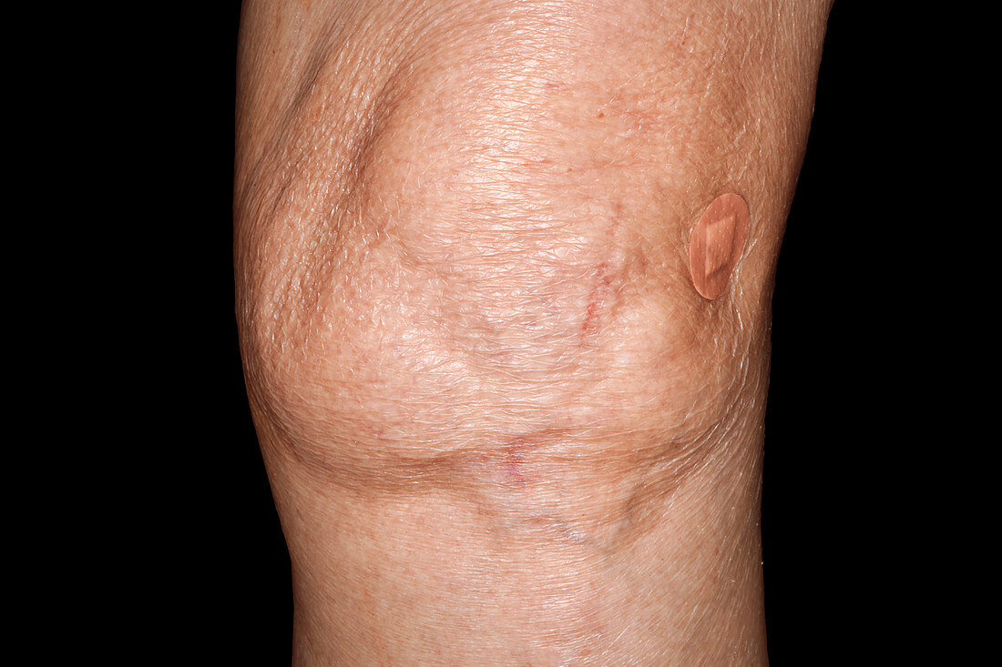 Swollen knee in osteoarthritis