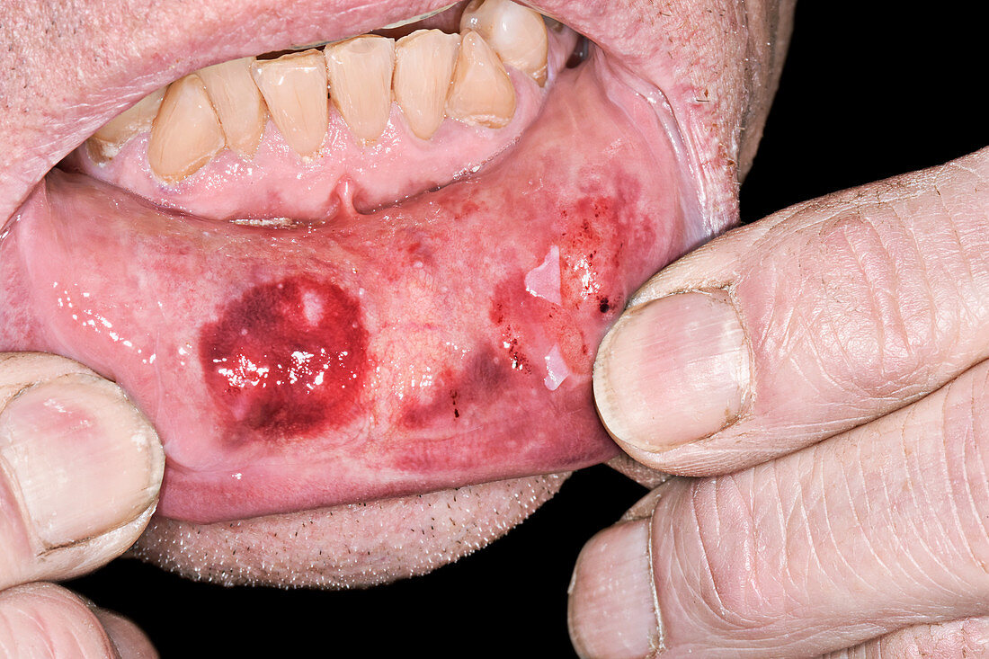 Contusions inside the mouth after an assault