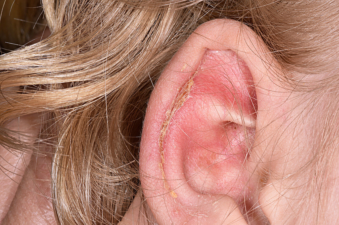 Impetigo infection on ear – acheter une photo – 12643030 ...