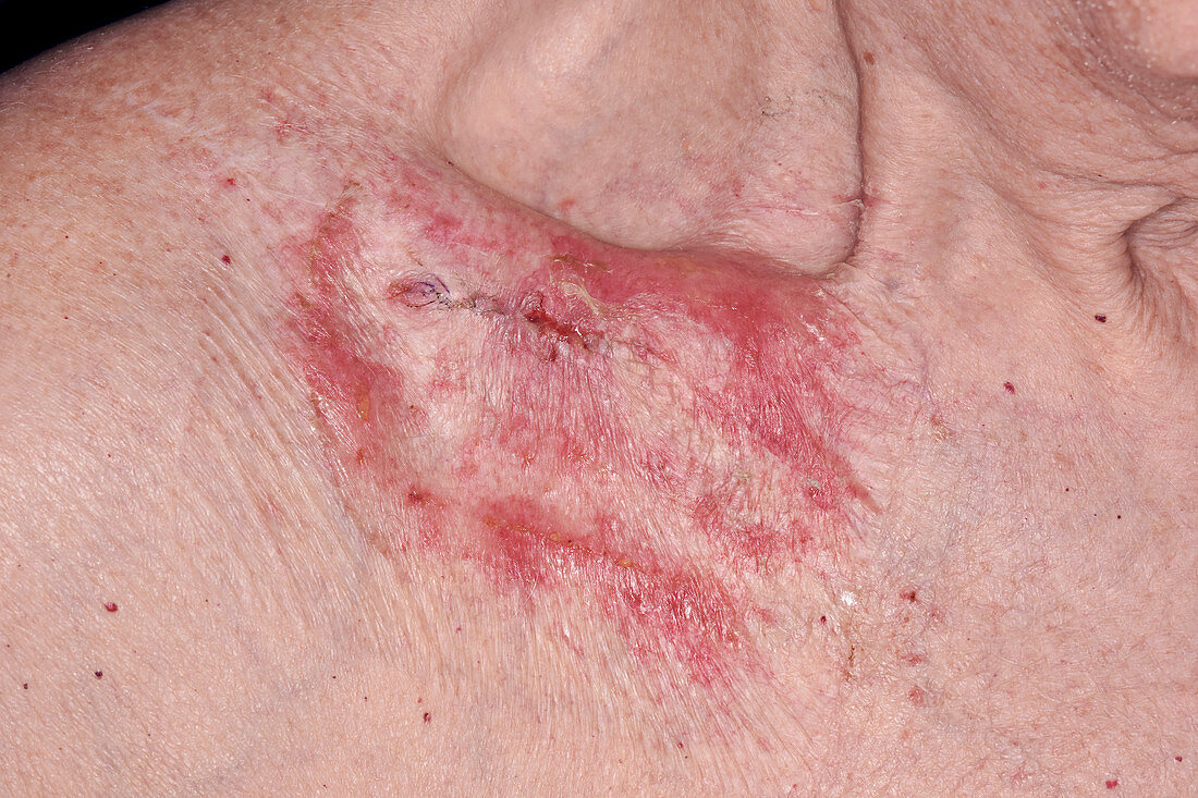 Allergic rash following surgery
