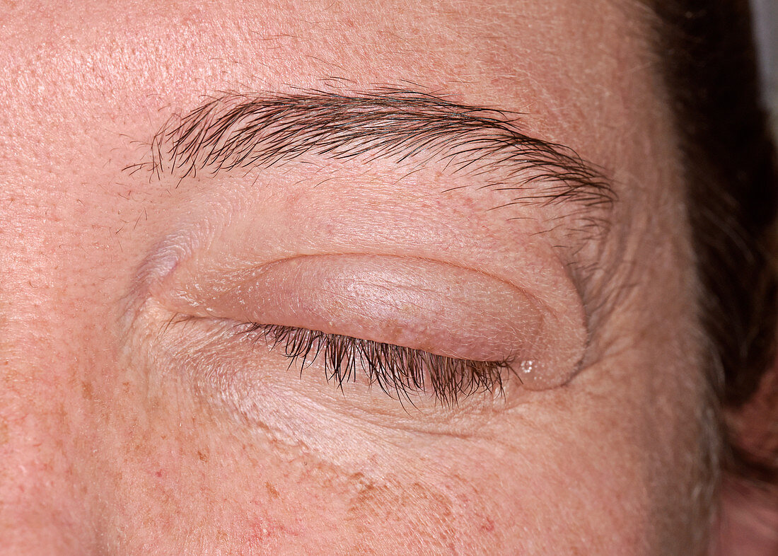 Angioedema eyelid swelling
