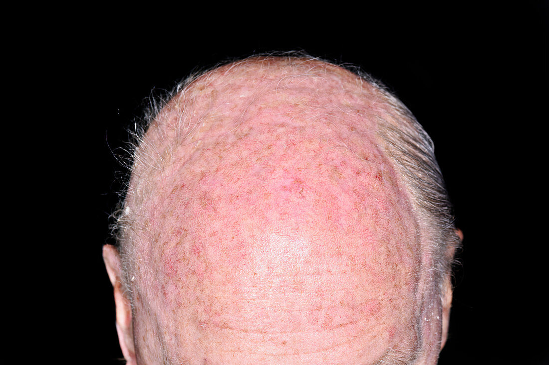 Hair loss due to chemotherapy