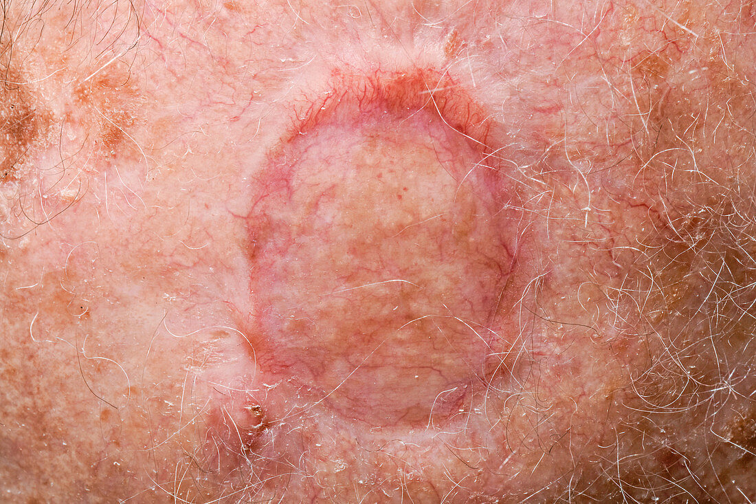 Skin graft after squamous cell carcinoma excision