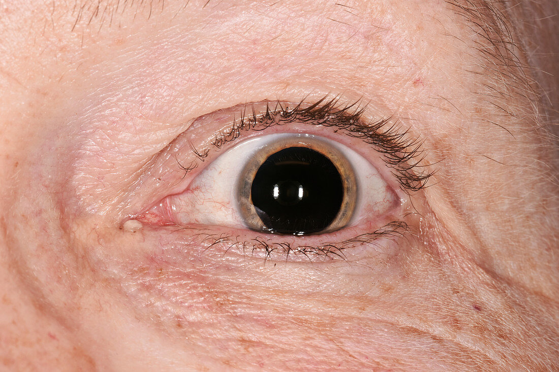 Dilated pupil for an eye examination