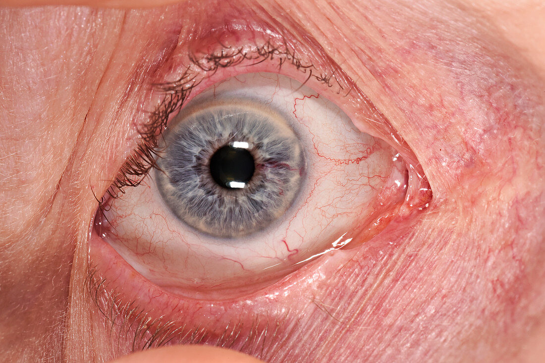 Arteriovenous malformation in an eye