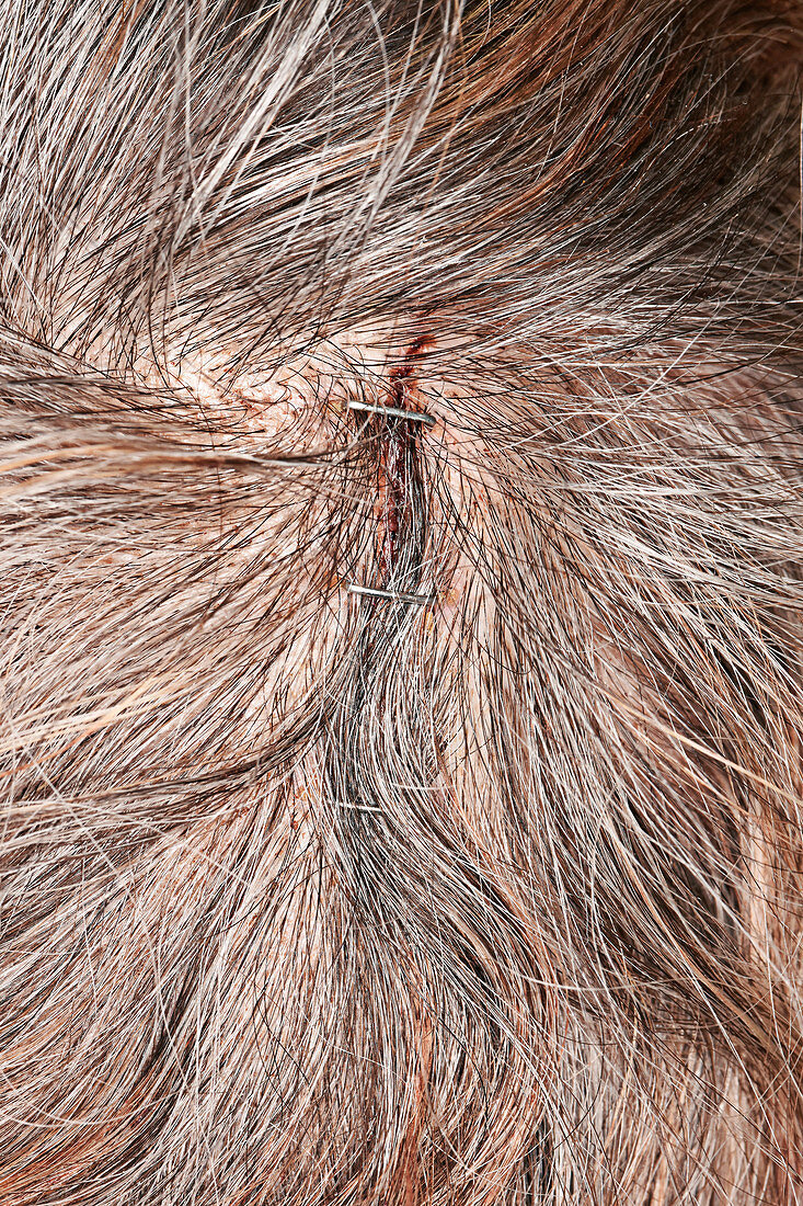 Stapled scalp laceration