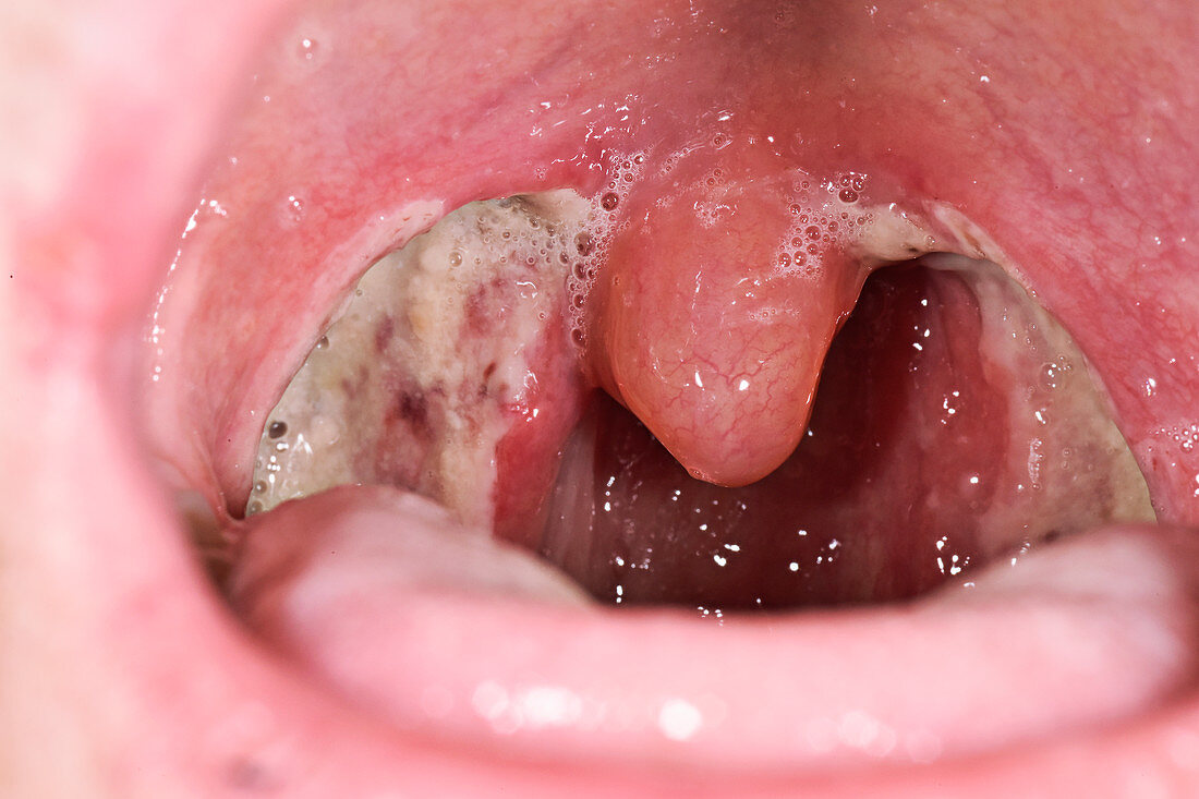 Throat after tonsils removal
