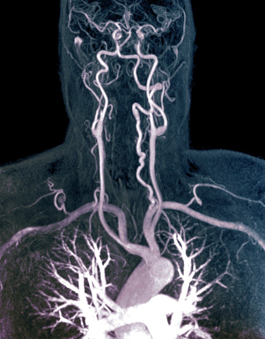 Cervical artery dissection, MRI angiogram
