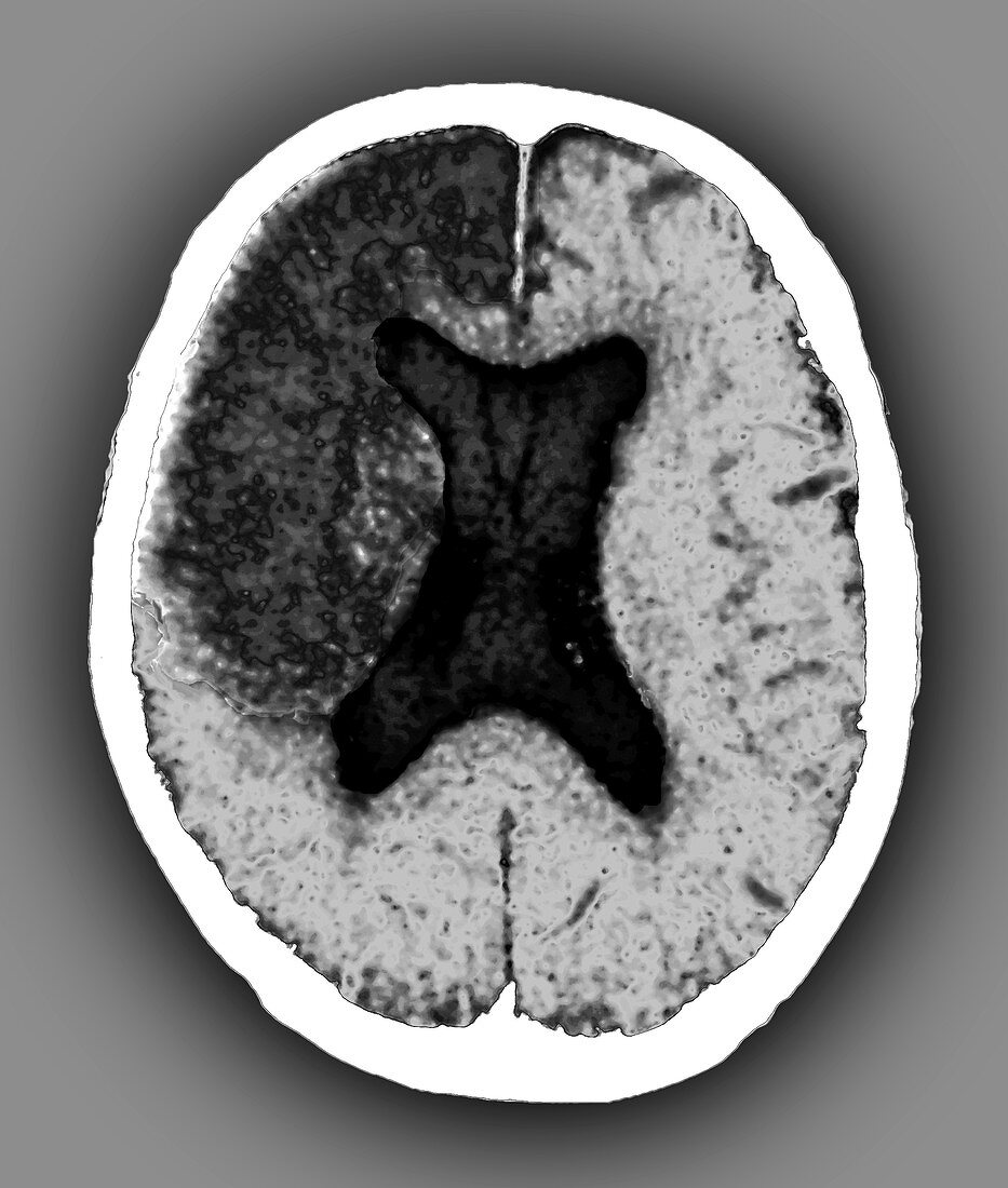 Cerebral infarction, CT scan