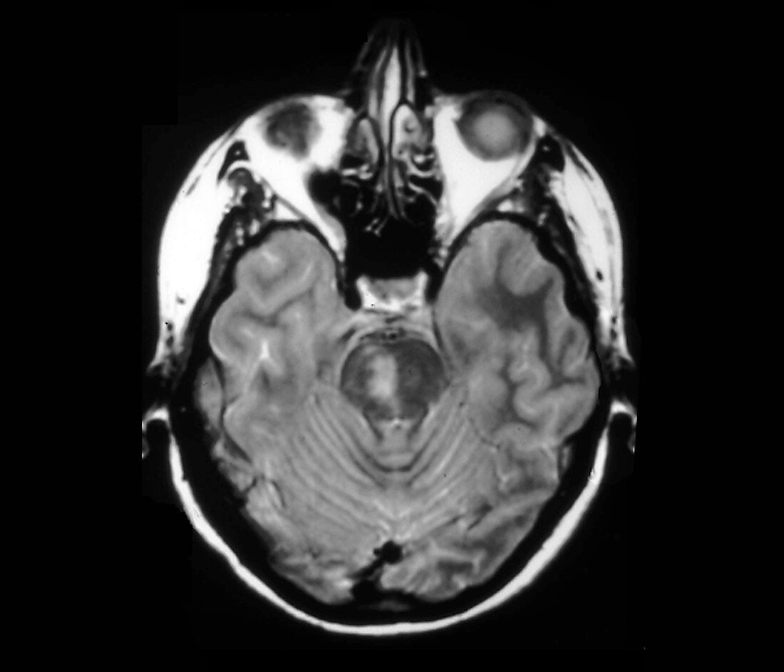 Brainstem stroke, MRI scan