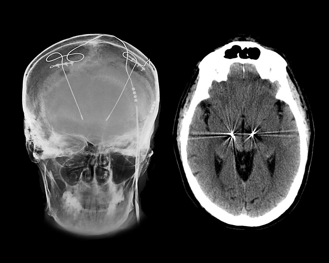 Parkinson's disease brain stimulation electrodes